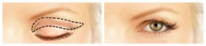 Dra. Júlia Soares Blefaroplastia- Tubarão - SC